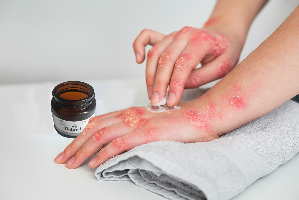 Ditch the Eczema Itch with Ozonated Oils: A Natural Solution You Shouldn't Miss