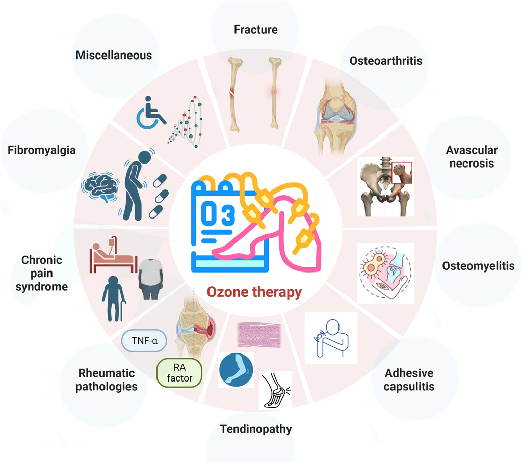 Ozone therapy in musculoskeletal medicine: a comprehensive review