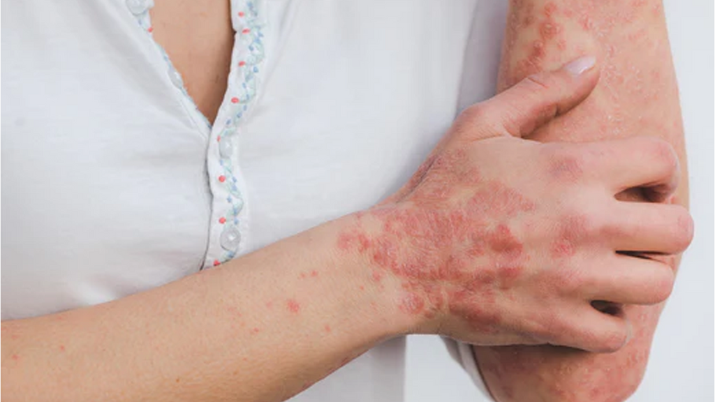 Can Topical Ozone Treat Psoriasis?
